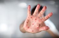 02/02/2024 – El sarampión es una enfermedad viral muy contagiosa, a veces letal, que afecta sobre todo a niños y niñas, y la…