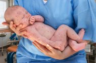 25/07/2018 – El Ministerio de Salud de la Nación confirmó dos nuevos casos de bebés con sarampión que elevaron a tres los cuadros…